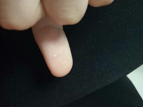 手指上这个白点是什么病?