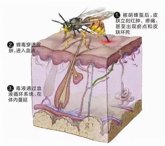 原创夫妻遭野蜂群攻击1死1重伤:被马蜂蜇伤后,母乳擦拭真的有效吗?